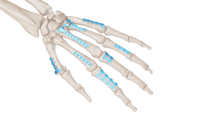 1.5 mm Mini Plaklar