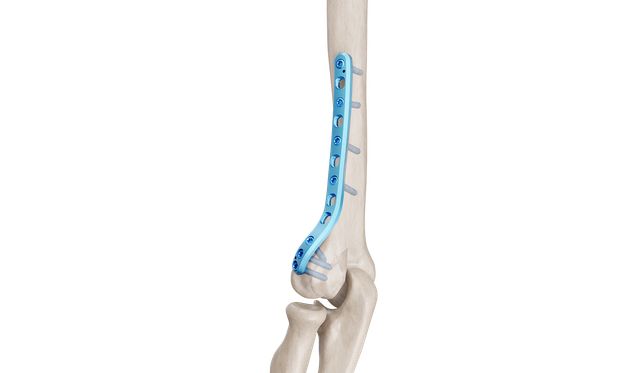 Distal Humerus Lateral Anatomik Plak