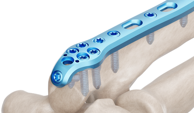 Olecranon Anatomik Plak