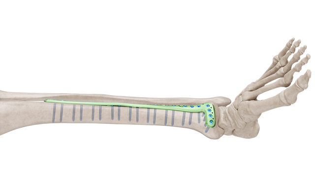 Distal Tibia Anterolateral Anatomik Plak