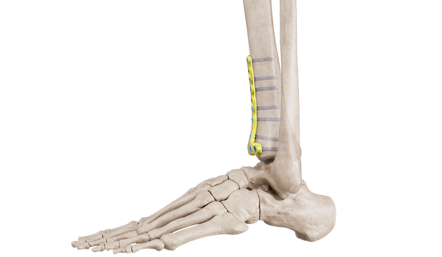Distal Tibia Anterior Plak
