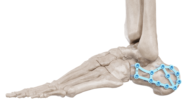 Calcaneus Plak