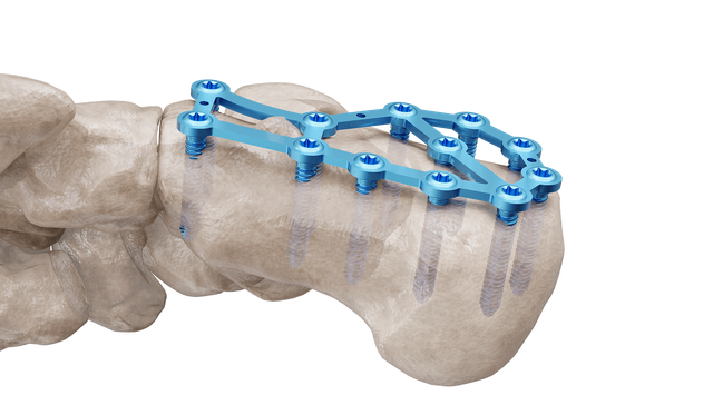 Calcaneus Plak
