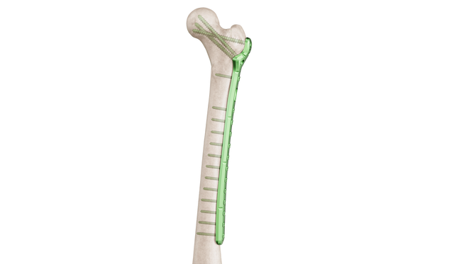 Proksimal Femur Lateral Anatomik Plak