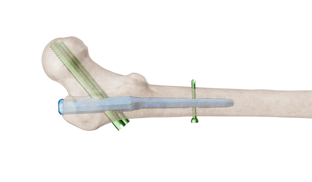 Proximal Femur Çivi (PFÇ) Plak