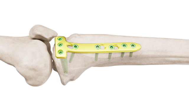 Proksimal Tibia Yüksek Osteotomi Plak