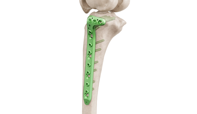 4.5 mm Proksimal Tibia Lateral Anatomik Plak