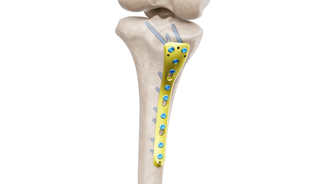 Proksimal Tibia Posteromedyal Plak