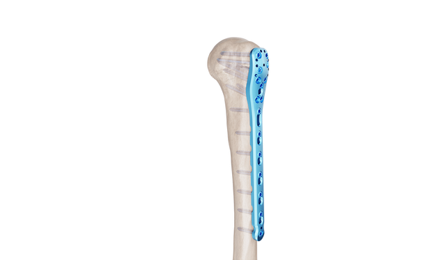 Proksimal Humerus Plak