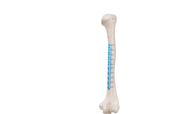 3.5 mm Humerus Düz Plak