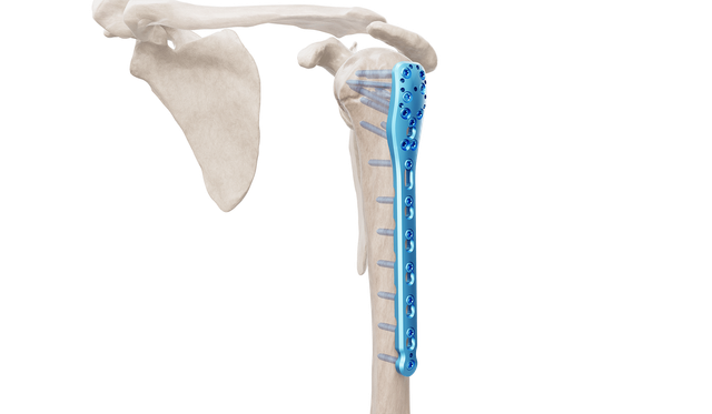 Proksimal Humerus Plak