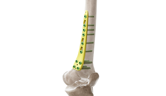 Distal Femur Medyal Anatomik Plak