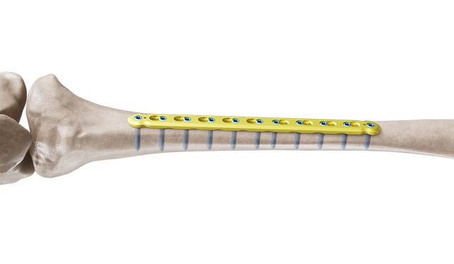Tibia Düz Plak