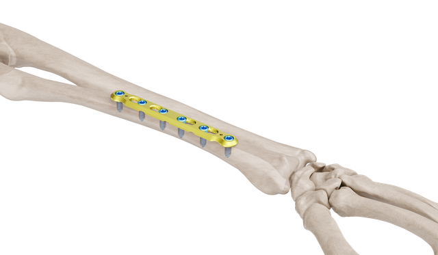 3.5 mm Ulna Radyus Plak