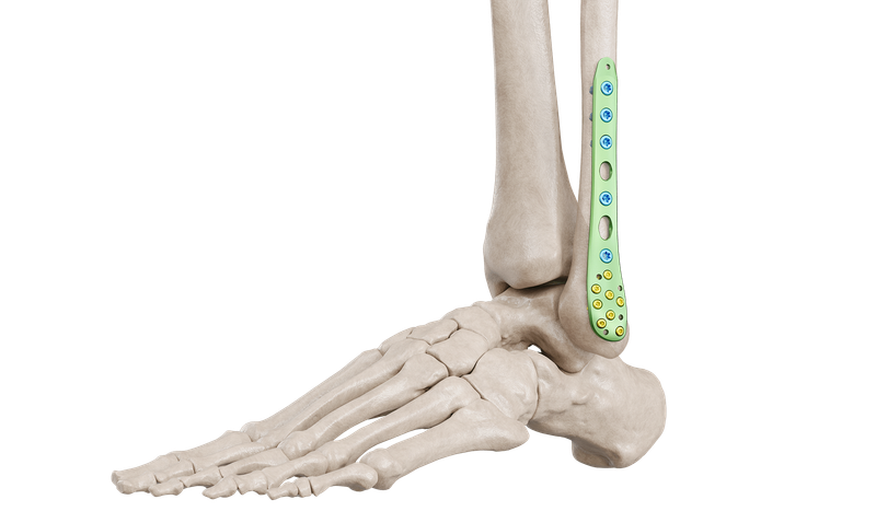 Distal Fibula Lateral Malleolar Anatomic Plate