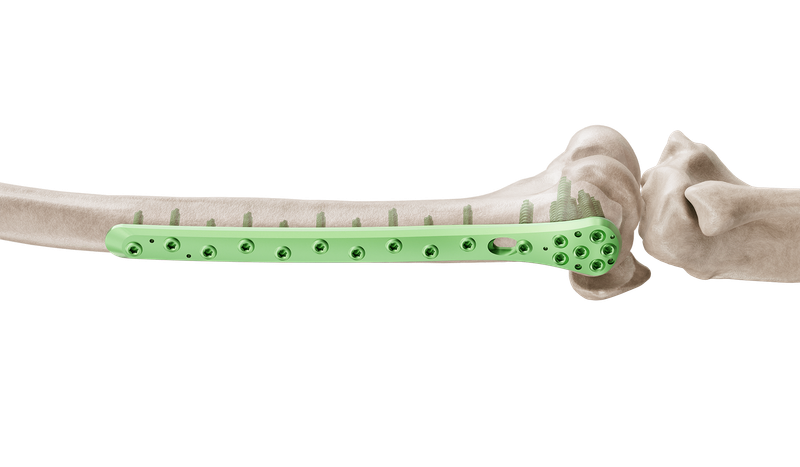Distal Fibula Lateral Malleolar Anatomik Plak