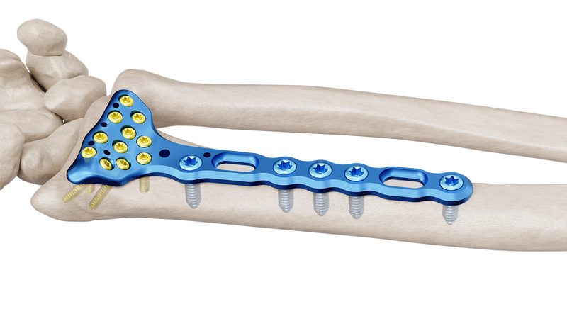 Distal Radius Volar Anatomic Wide Plate