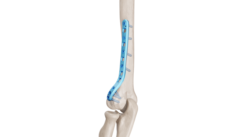 Distal Humerus Lateral Anatomik Plak