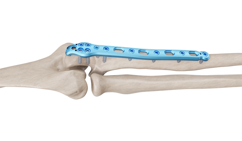 Olecranon Anatomik Plak