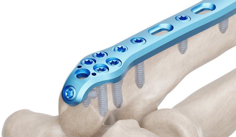 Olecranon Anatomik Plak