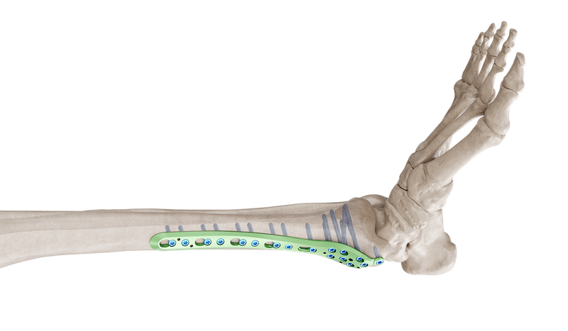 Distal Tibia Medyal Anatomik Plak