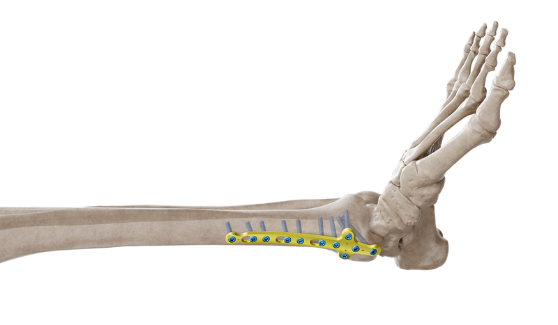 Placa Maleolar Medial de Tibia Distal