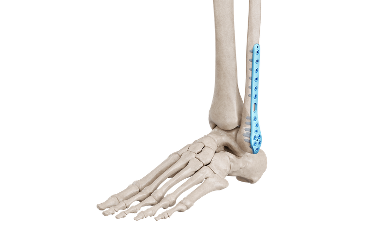 Distal Fibula Plak