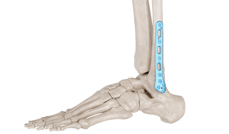 Placa Anatómica Posterolateral de Peroné Distal