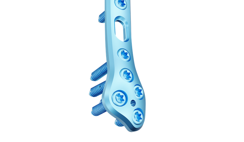 Distal Fibula Posterolateral Anatomik Plak