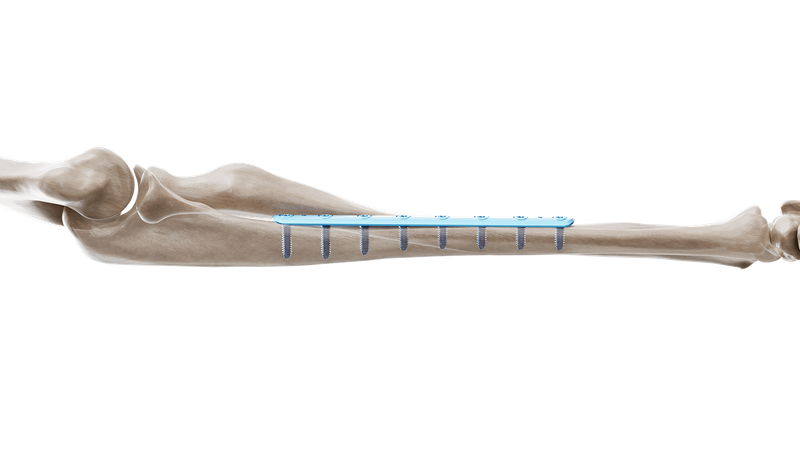 1/3 Tubular Straight Plate