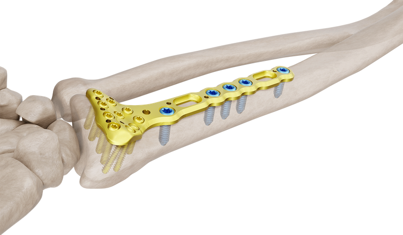 Distal Radyus Volar Anatomik Standart Plak
