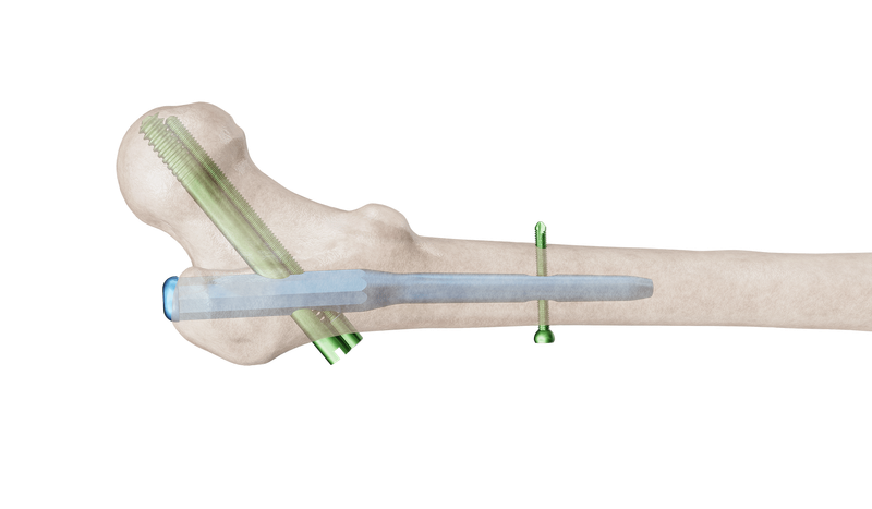 Proximal Femur Çivi (PFÇ) Plak