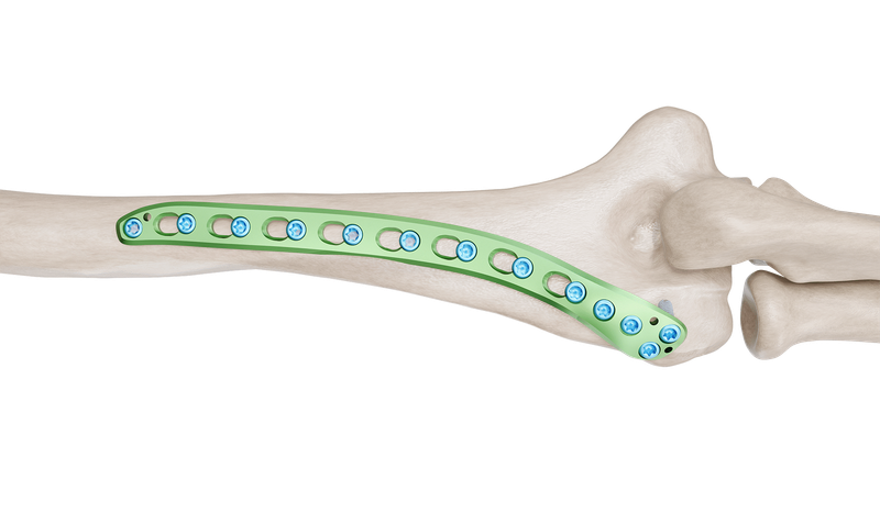 Distal Humerus Posterolateral Plak