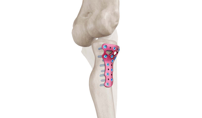 Placa de Cabeza Radial Proximal