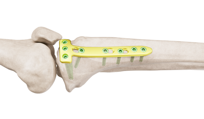 Placa de Osteotomía Alta de Tibia Proximal