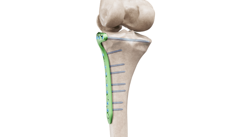 Proksimal Tibia Lateral Anatomik Plak