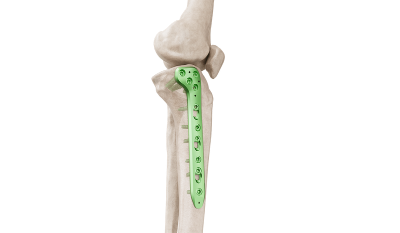 Placa Anatómica Medial de Tibia Proximal de 4,5 mm