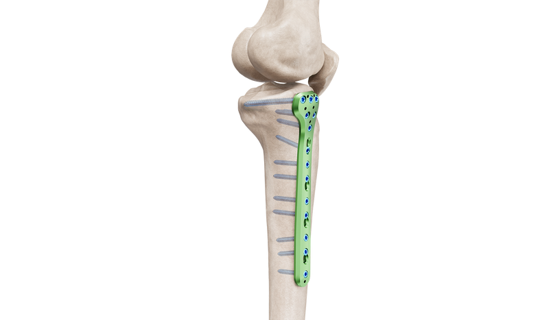 Proximal Tibia Medial Anatomic Plate