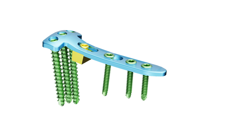 Proksimal Tibia Yüksek Osteotomi Plak