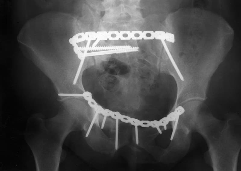 Pelvis Rekonstrüksiyon Düz Plak