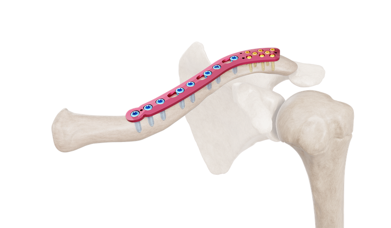 Superior Distal Clavicle Anatomic Plate