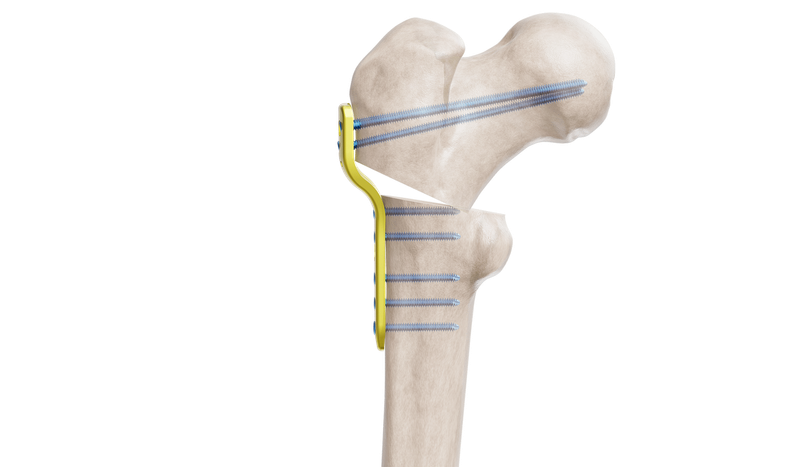 Pediatrik Kalça Proksimal Femur Plak