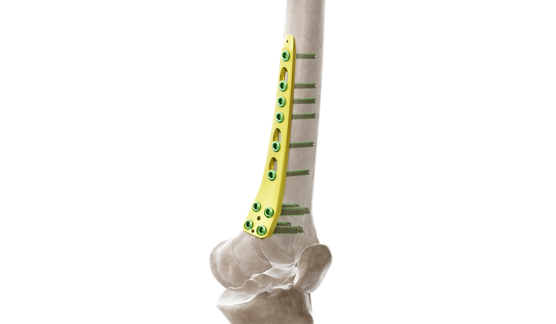 Distal Femur Medial Anatomic Plate