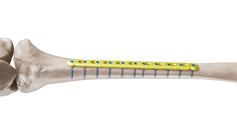 Placa Recta de Tibia