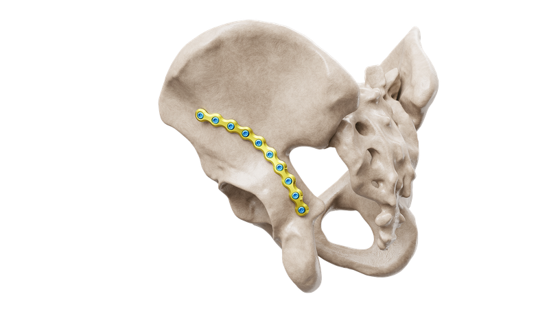 Pelvis Reconstruction Curved Plate