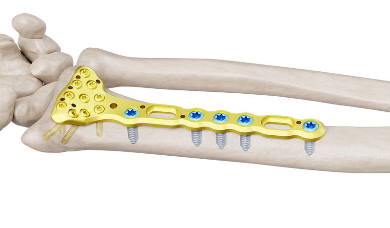 Distal Radius Volar Anatomic Standart Plate