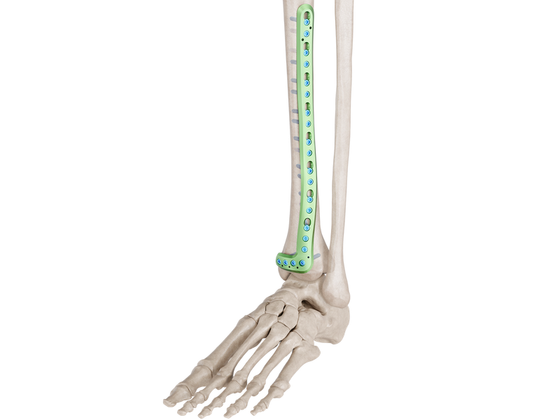 Distal Tibia Anterolateral Placa Anatómica