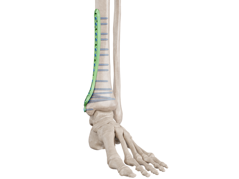 Distal Tibia Медиальная Анатомическая пластина