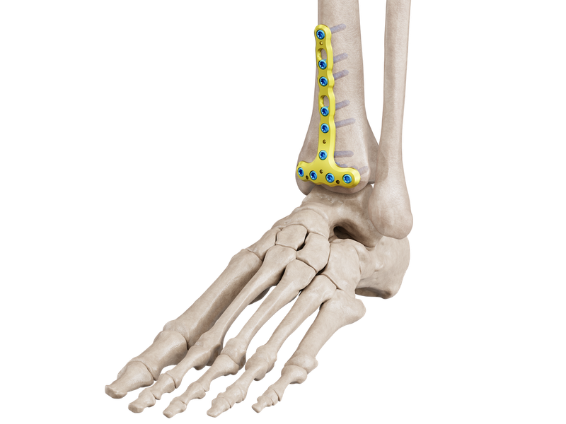 Distal Tibia Anterior Placa