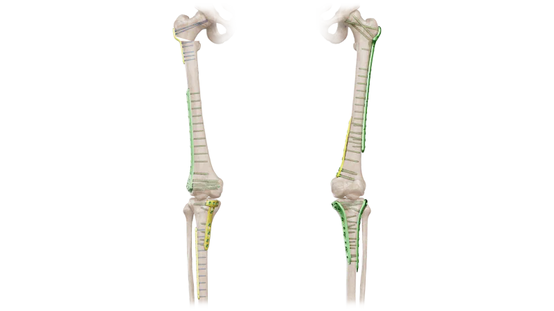 Tibia & Femur